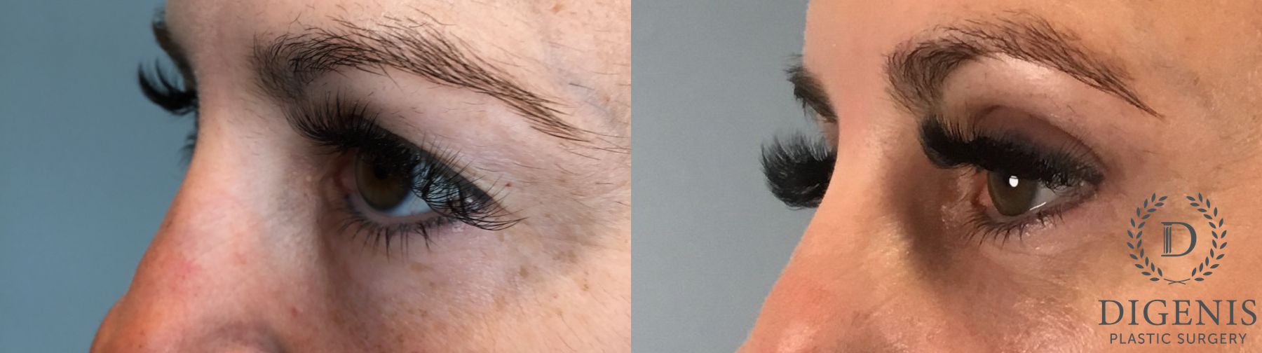 Before and after Eye Lid Surgery case 41732 - Angle 4