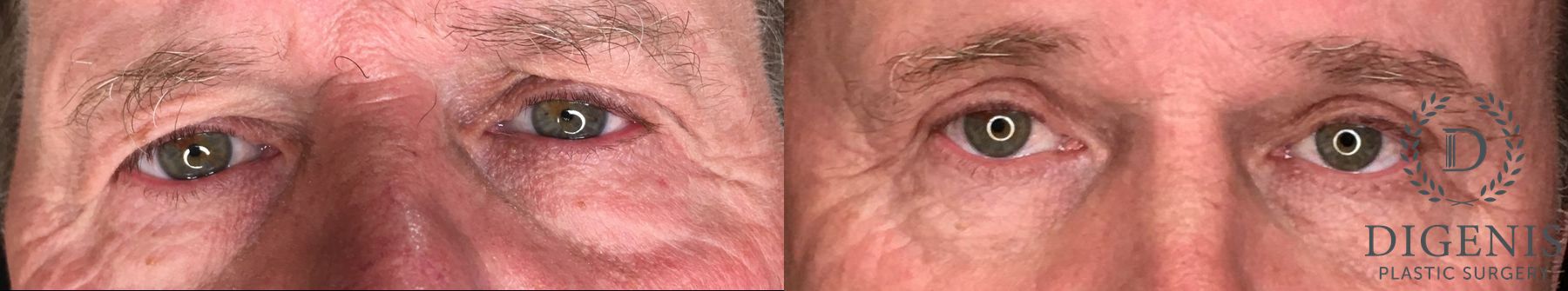 Before and after Eye Lid Surgery case 35183