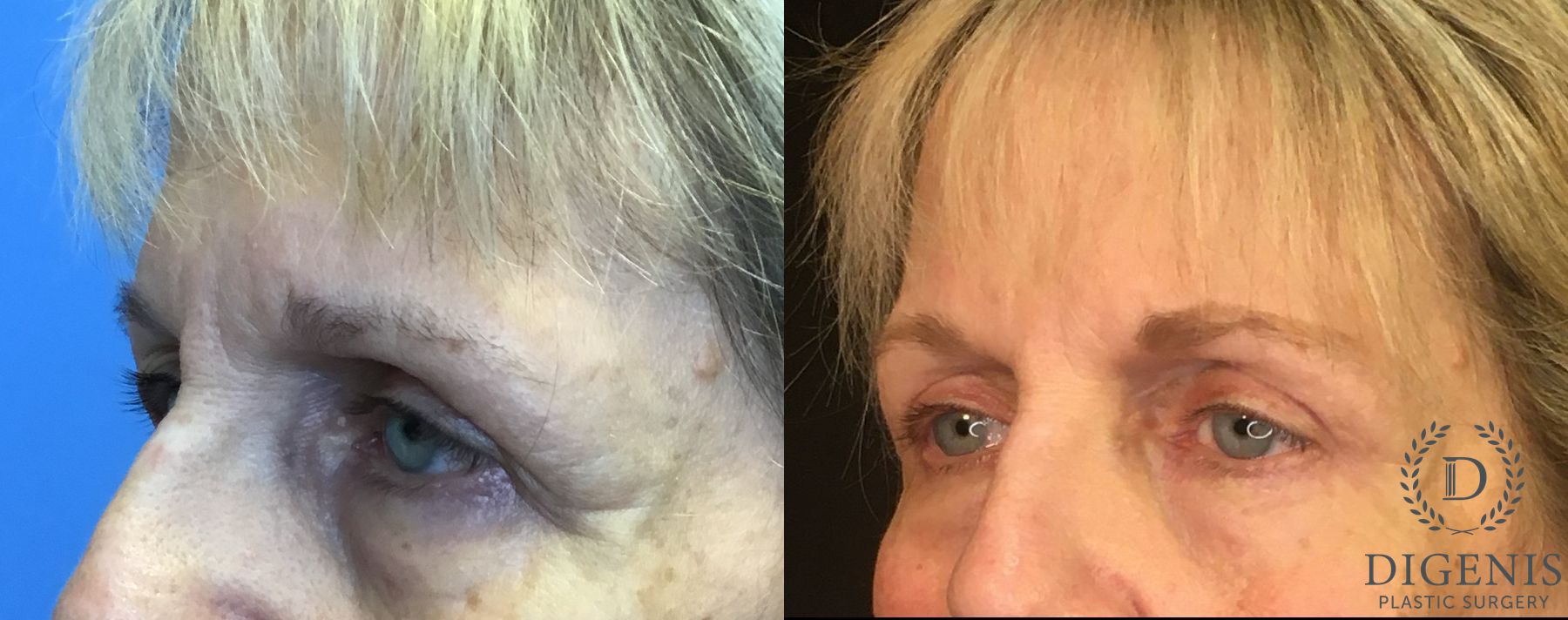 Before and after Eye Lid Surgery case 35109 - Angle 4