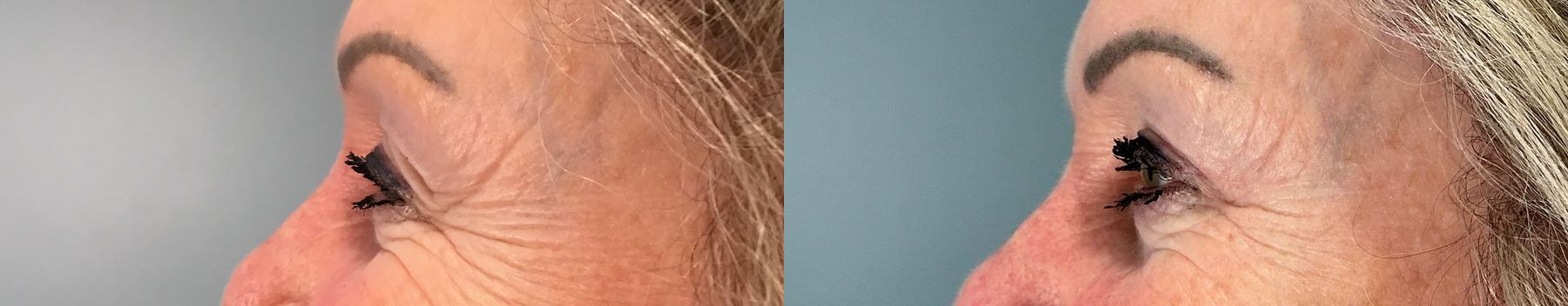 Before and after Eye Lid Surgery case 49986 - Angle 3