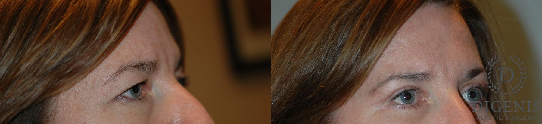 Before and after Eye Lid Surgery case 35086 - Angle 2