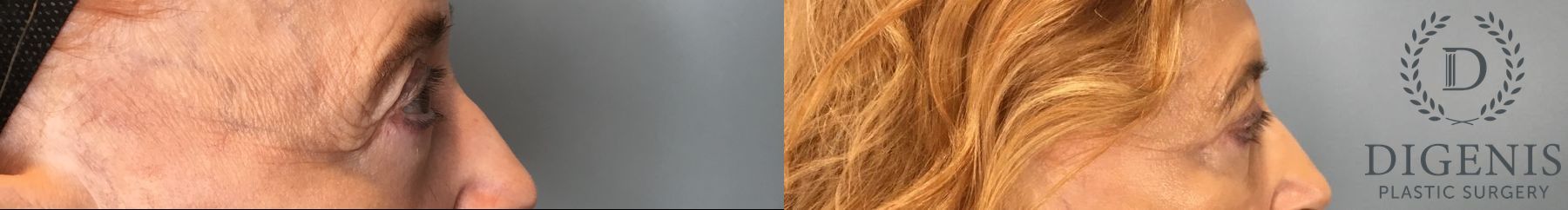 Before and after Eye Lid Surgery case 43075 - Angle 4