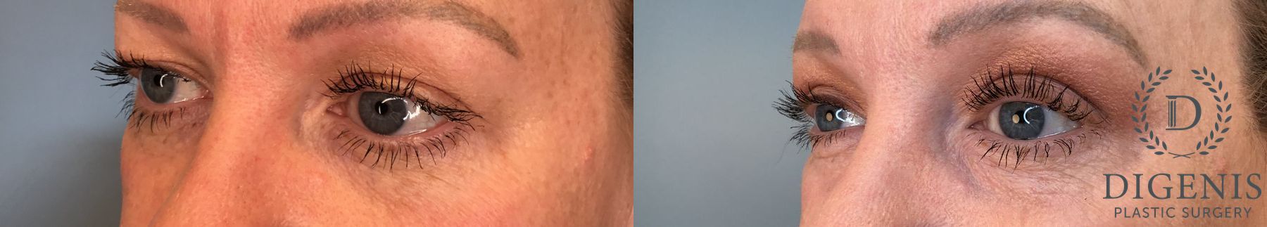 Before and after Eye Lid Surgery case 41341 - Angle 2