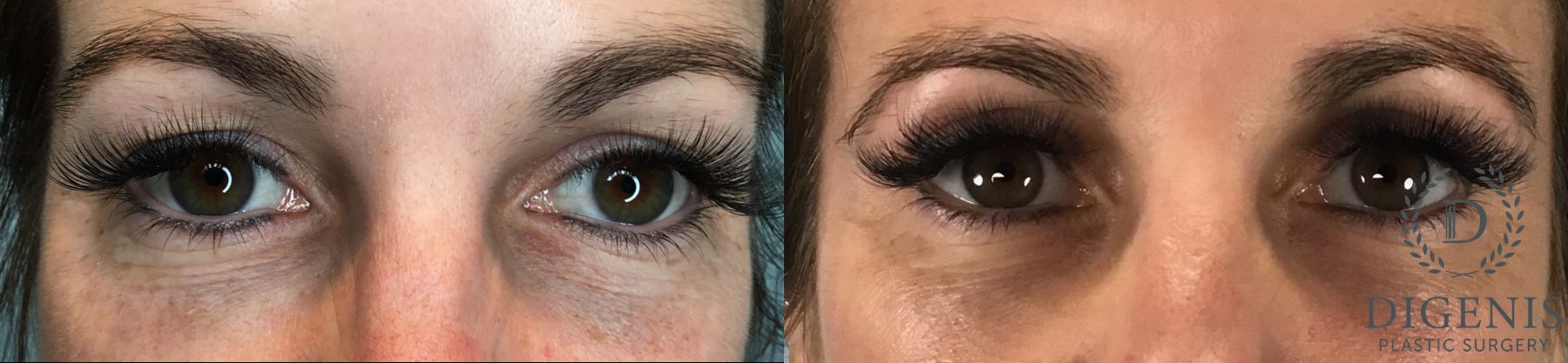 Before and after Eye Lid Surgery case 41732