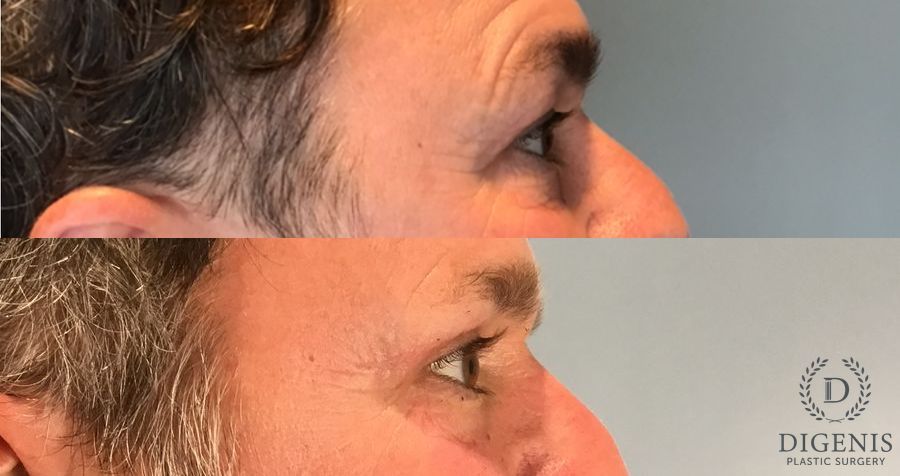 Before and after Eye Lid Surgery case 46363 - Angle 3