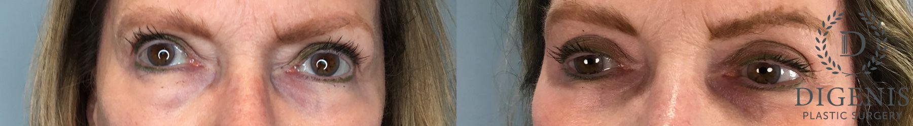 Before and after Eye Lid Surgery case 43261 - Angle 5