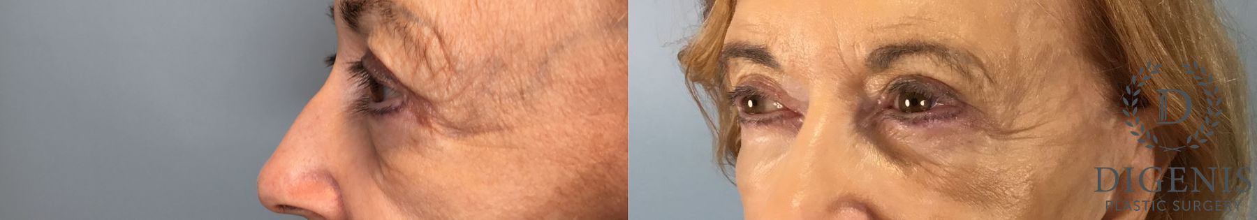 Before and after Eye Lid Surgery case 43075 - Angle 3