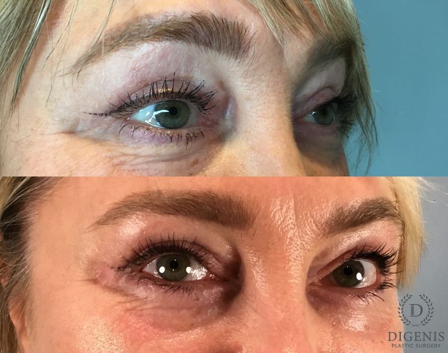 Before and after Eye Lid Surgery case 49417 - Angle 2