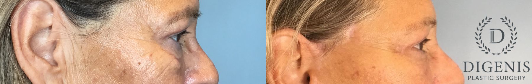 Before and after Eye Lid Surgery case 41927 - Angle 4