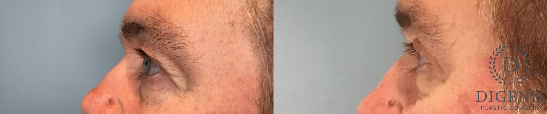 Before and after Eye Lid Surgery case 43247 - Angle 3