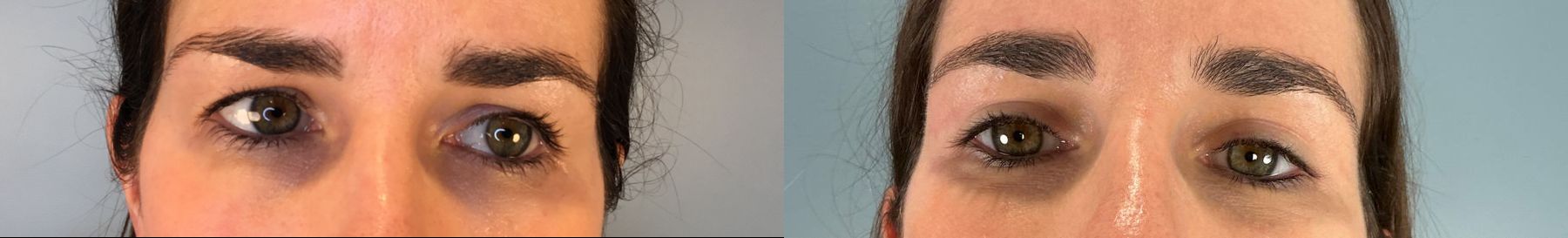 Before and after Eye Lid Surgery case 49981