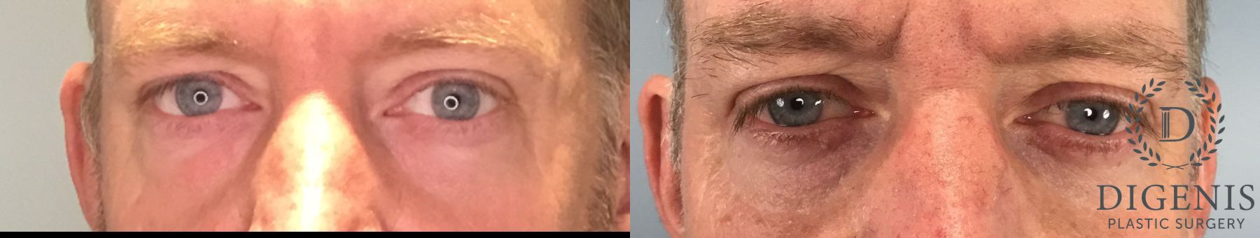 Before and after Eye Lid Surgery case 41739