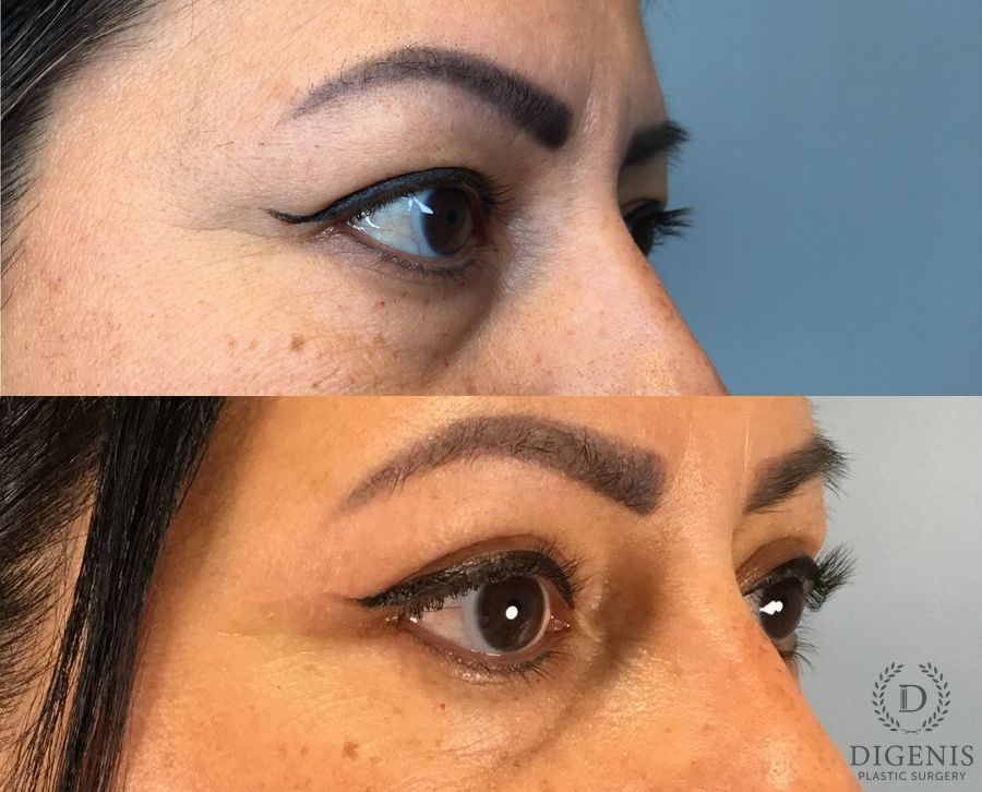 Before and after Eye Lid Surgery case 49483 - Angle 4