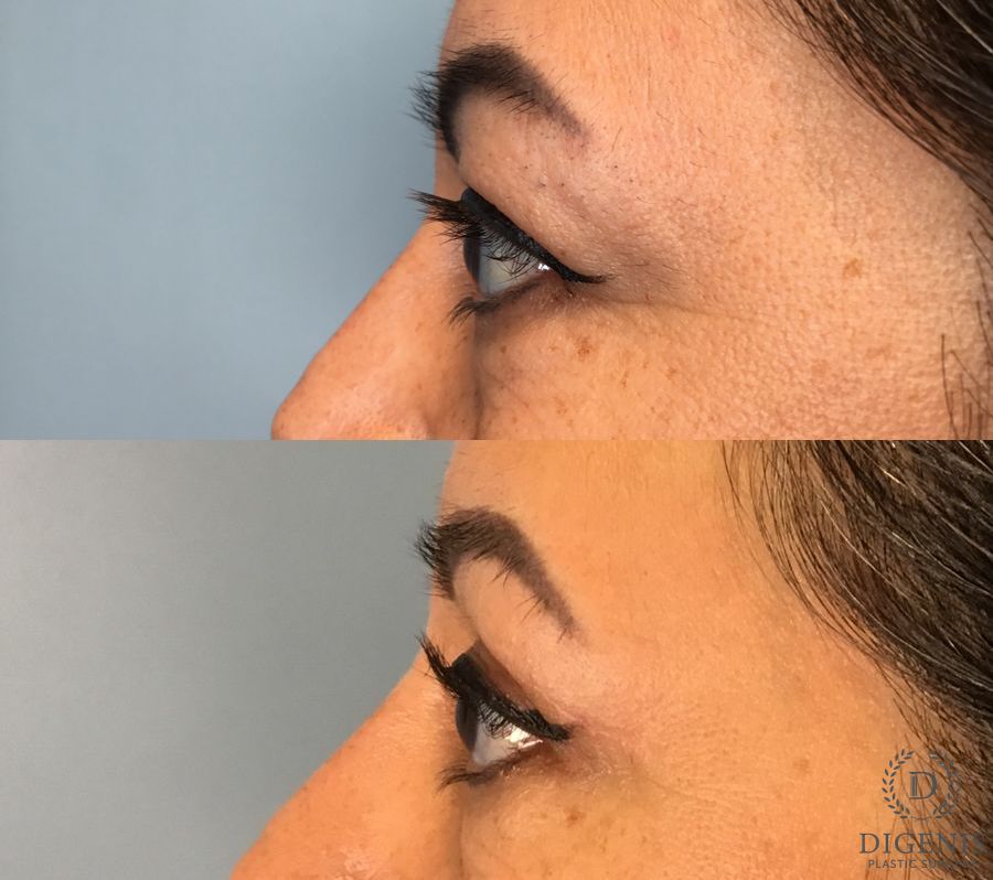 Before and after Eye Lid Surgery case 49483 - Angle 3
