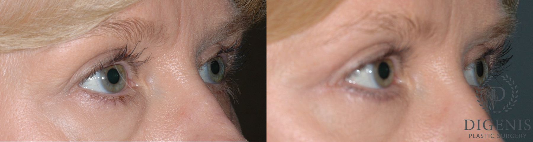 Before and after Eye Lid Surgery case 35104 - Angle 2