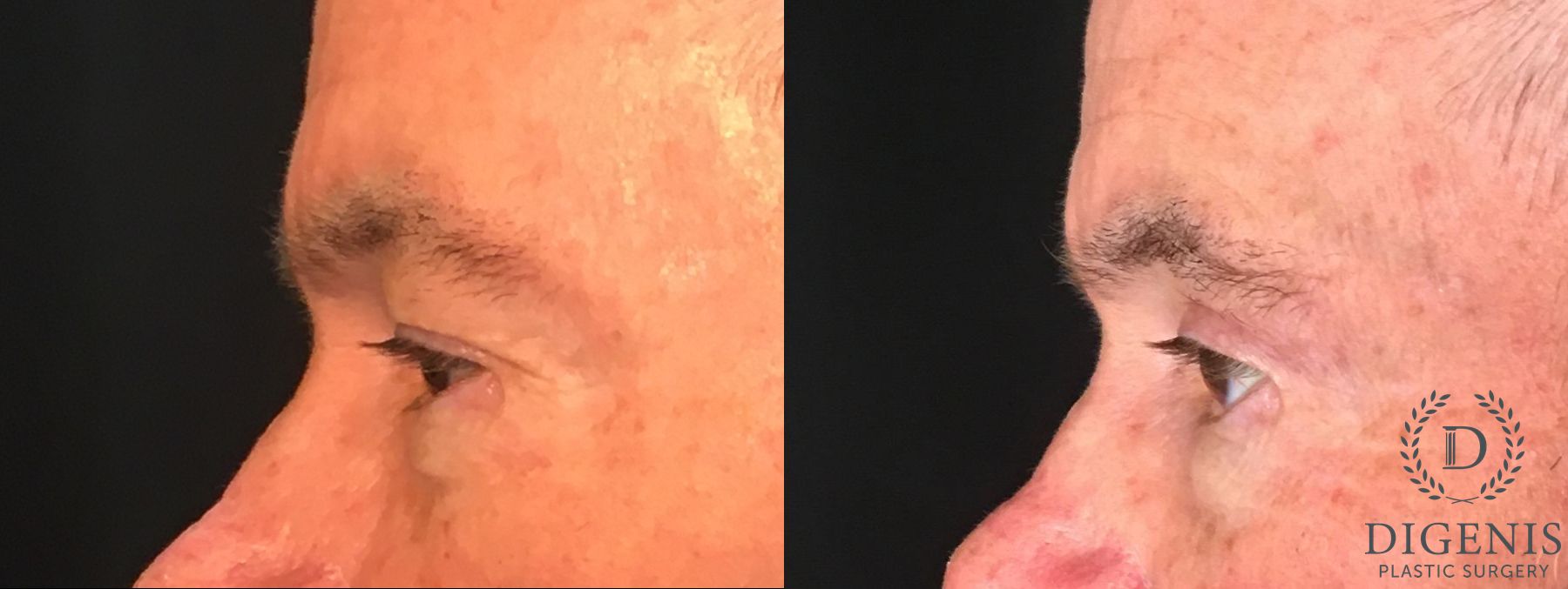 Before and after Eyelid Surgery case 35158 - Angle 5