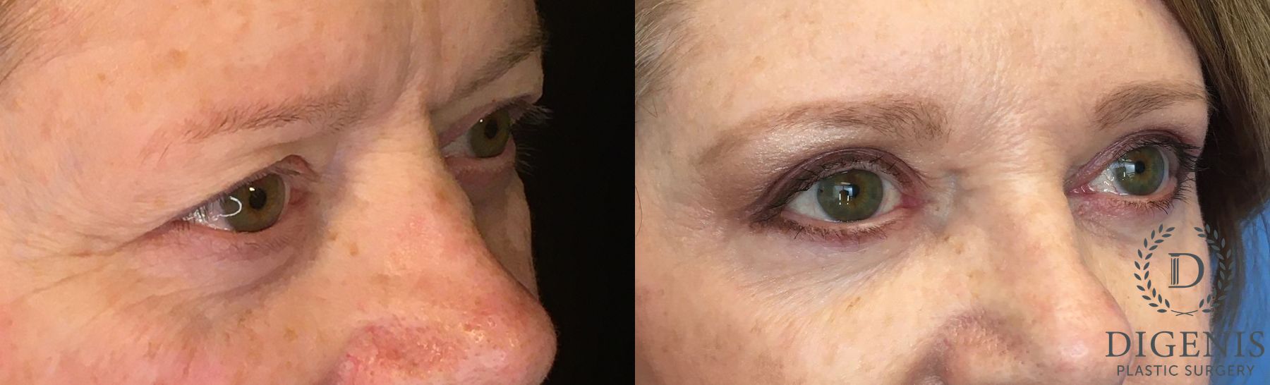 Before and after Eye Lid Surgery case 35146 - Angle 2