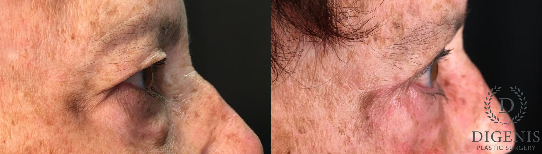 Before and after Eye Lid Surgery case 35193 - Angle 3