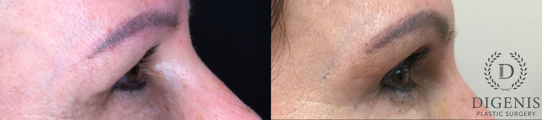 Before and after Eye Lid Surgery case 35179 - Angle 3