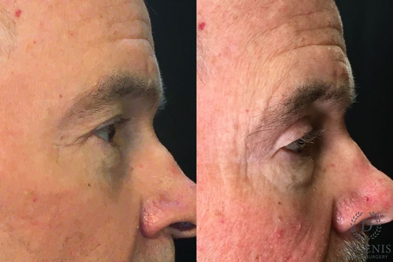 Before and after Eyelid Surgery case 35158 - Angle 3