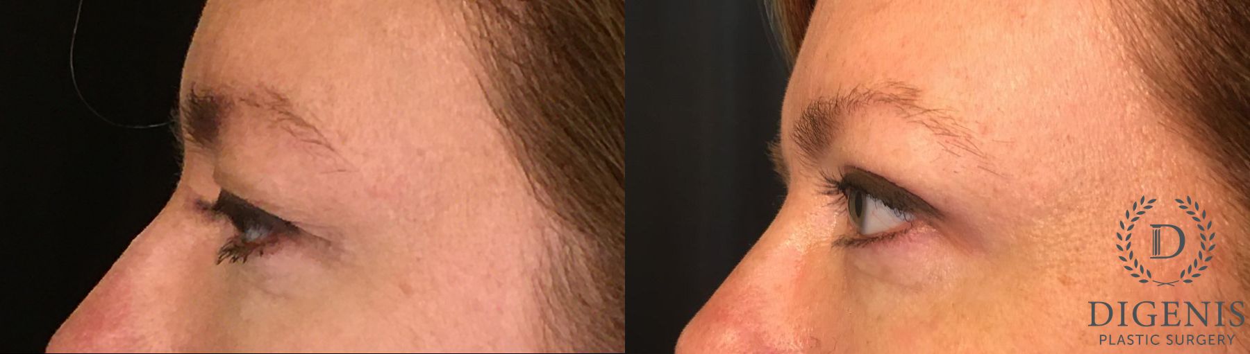 Before and after Eyelid Surgery case 35129 - Angle 3