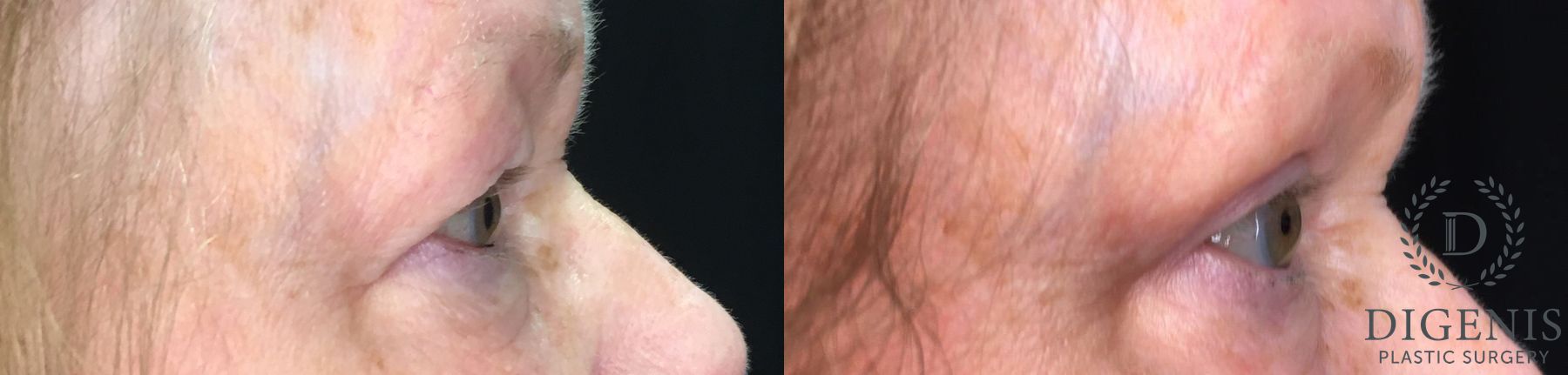 Before and after Eye Lid Surgery case 35170 - Angle 3