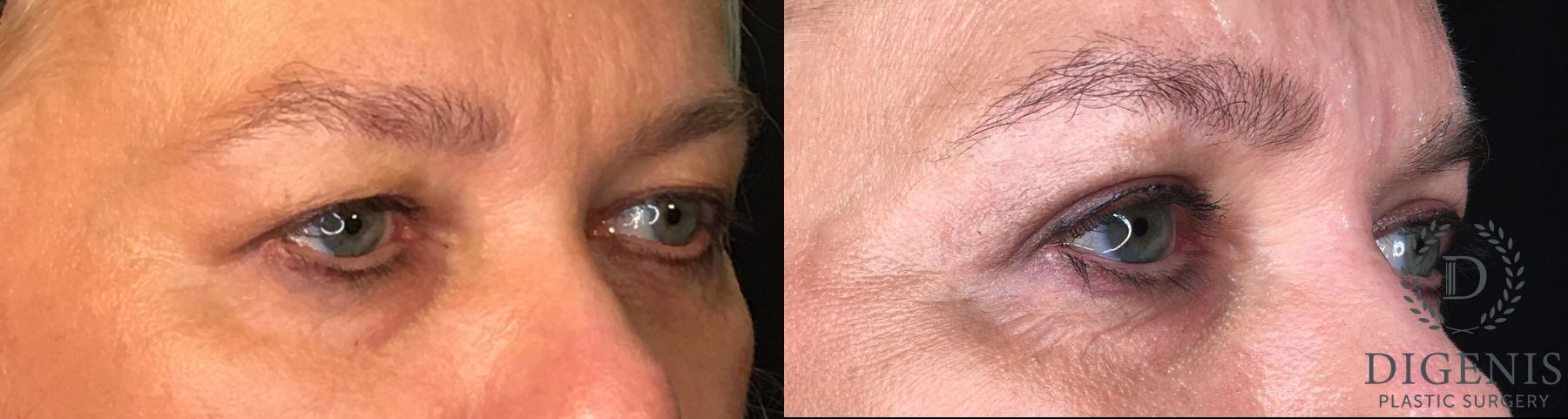 Before and after Eyelid Surgery case 35161 - Angle 4