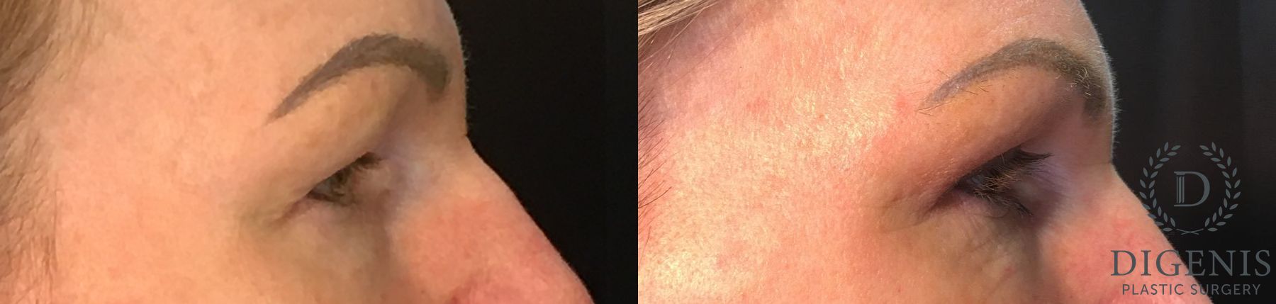 Before and after Eye Lid Surgery case 35145 - Angle 3