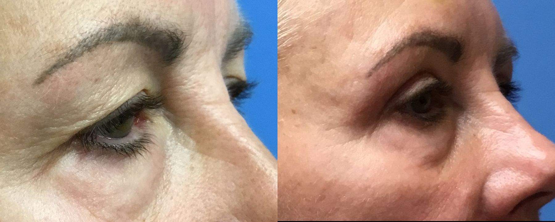 Before and after Eye Lid Surgery case 35112 - Angle 2