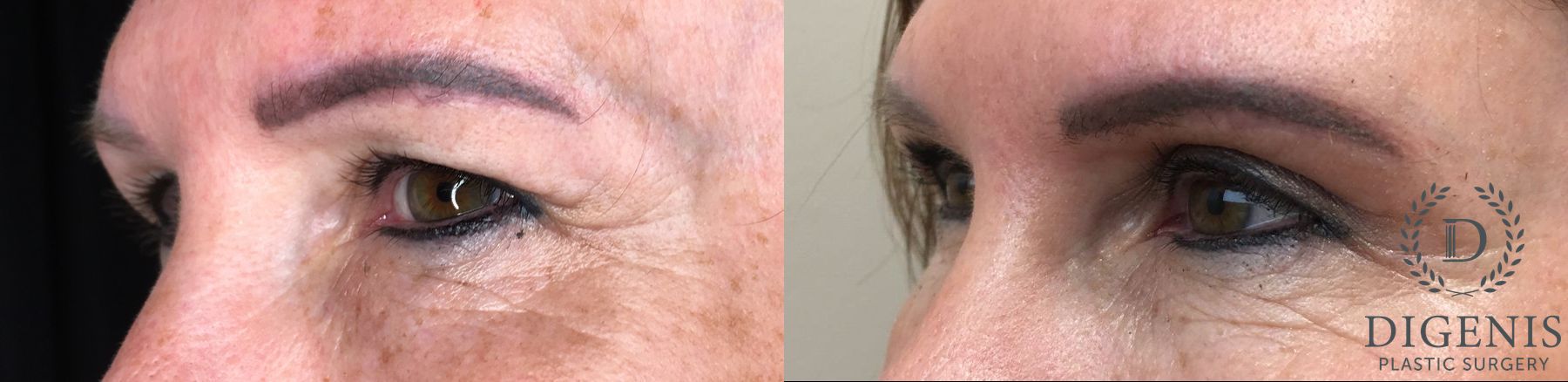 Before and after Eye Lid Surgery case 35179 - Angle 4