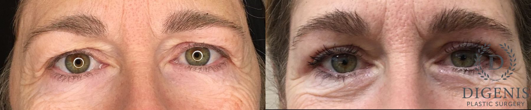 Before and after Eye Lid Surgery case 35204