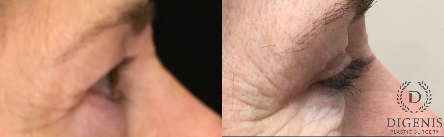 Before and after Eye Lid Surgery case 35204 - Angle 3