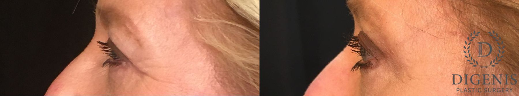 Before and after Eye Lid Surgery case 35154 - Angle 5