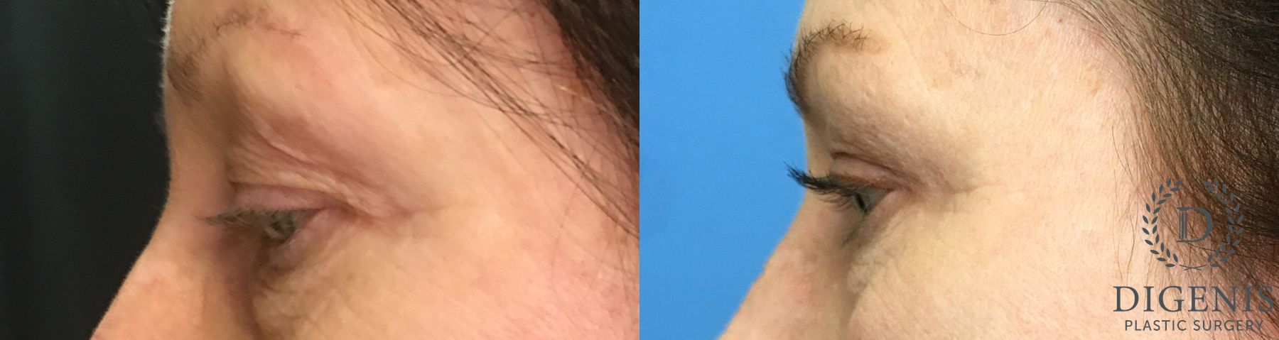 Before and after Eyelid Surgery case 35163 - Angle 5