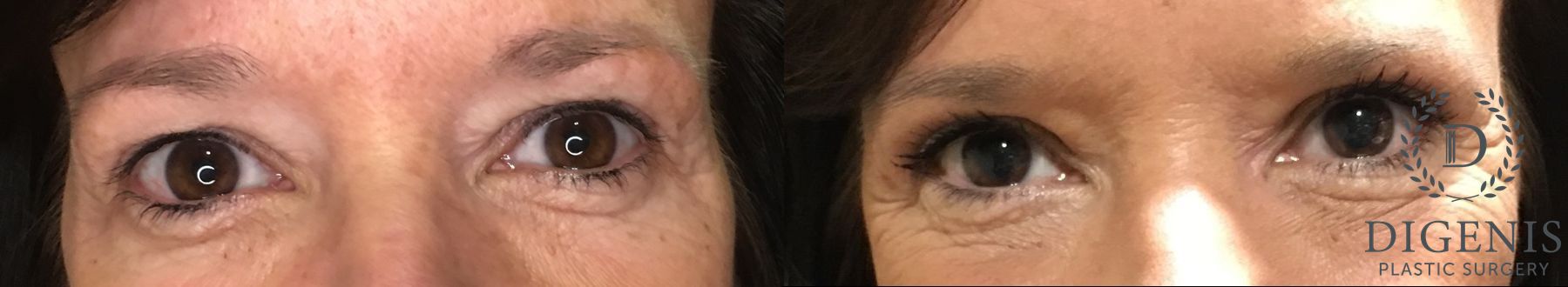 Before and after Eye Lid Surgery case 35192