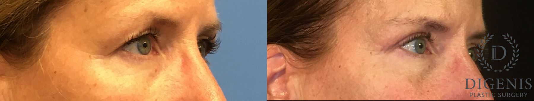 Before and after Eye Lid Surgery case 35059 - Angle 2