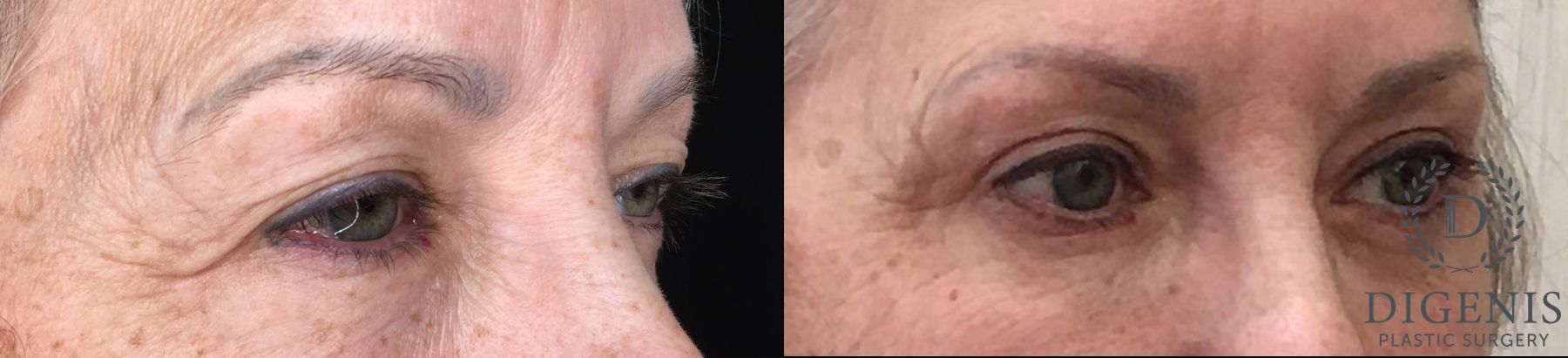 Before and after Eye Lid Surgery case 35190 - Angle 2