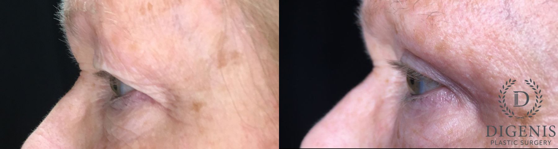 Before and after Eye Lid Surgery case 35170 - Angle 5