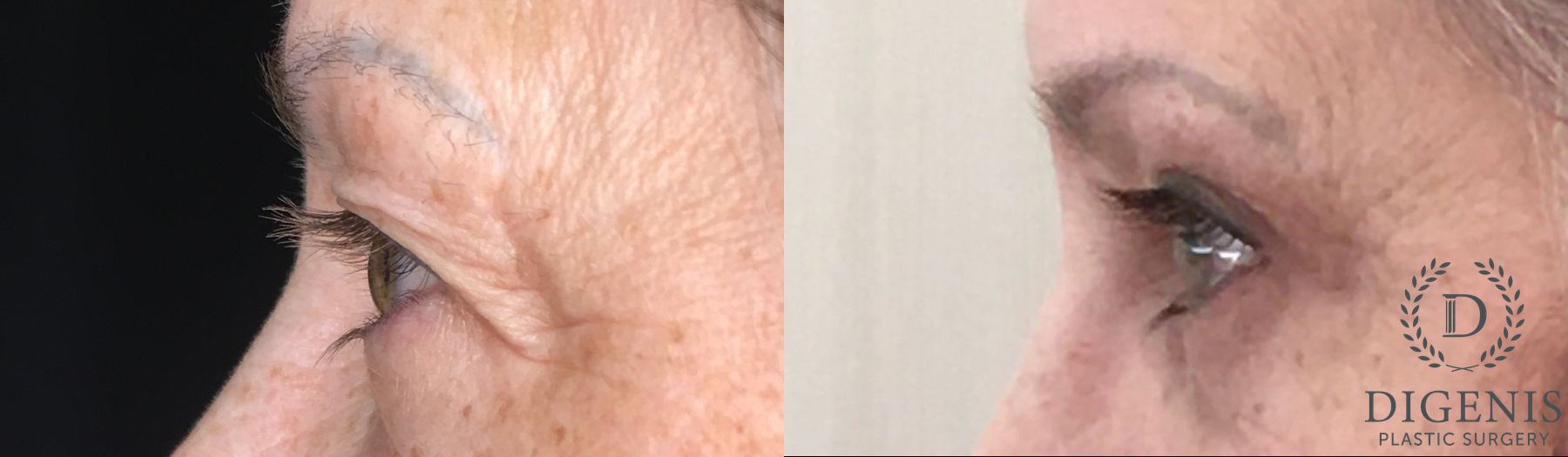 Before and after Eye Lid Surgery case 35190 - Angle 5