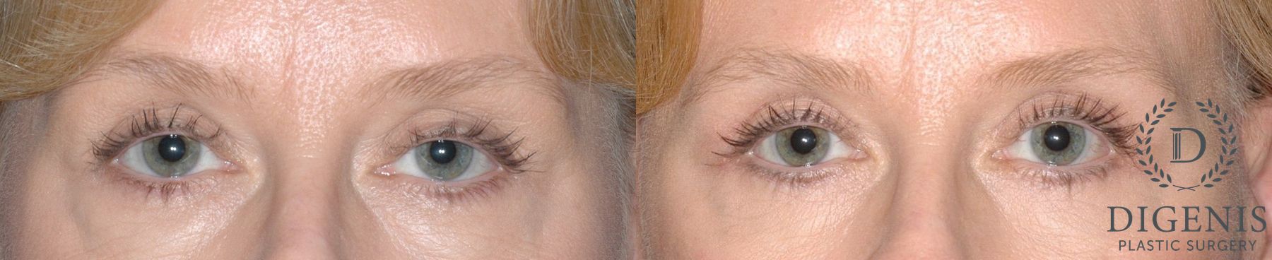 Before and after Eye Lid Surgery case 35104