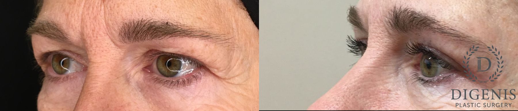 Before and after Eye Lid Surgery case 35204 - Angle 4