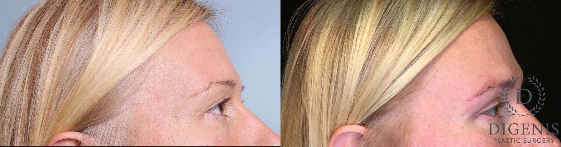 Before and after Eye Lid Surgery case 35108 - Angle 2