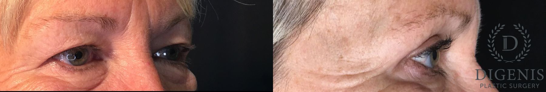 Before and after Eye Lid Surgery case 35208 - Angle 2