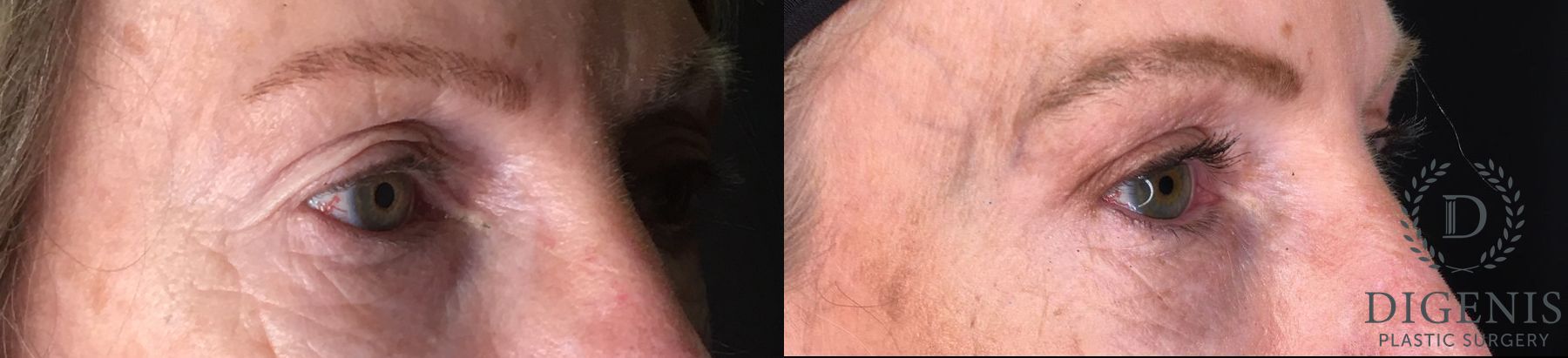 Before and after Eyelid Surgery case 35175 - Angle 2