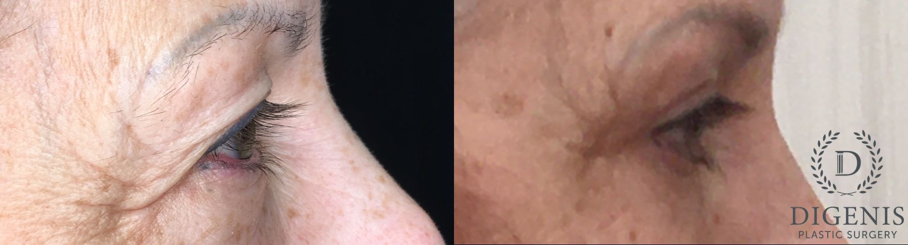 Before and after Eye Lid Surgery case 35190 - Angle 3