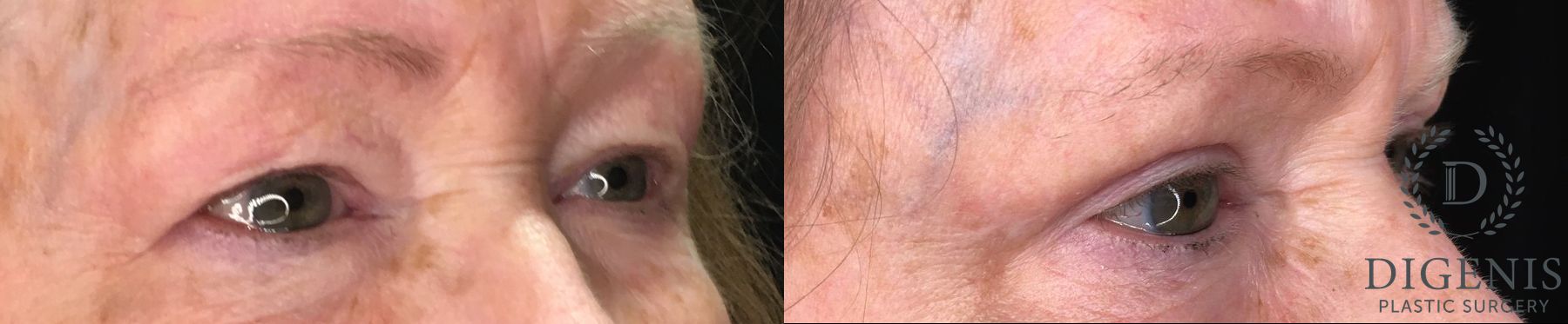 Before and after Eye Lid Surgery case 35170 - Angle 2