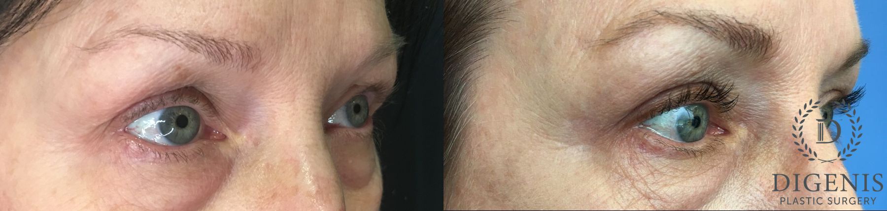 Before and after Eyelid Surgery case 35163 - Angle 2