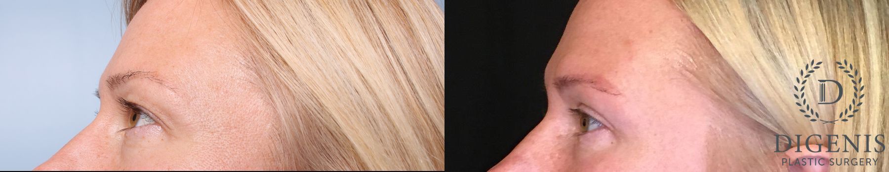 Before and after Eye Lid Surgery case 35108 - Angle 4