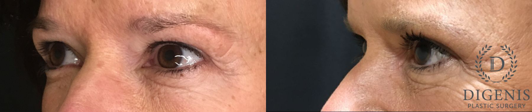 Before and after Eye Lid Surgery case 35192 - Angle 4