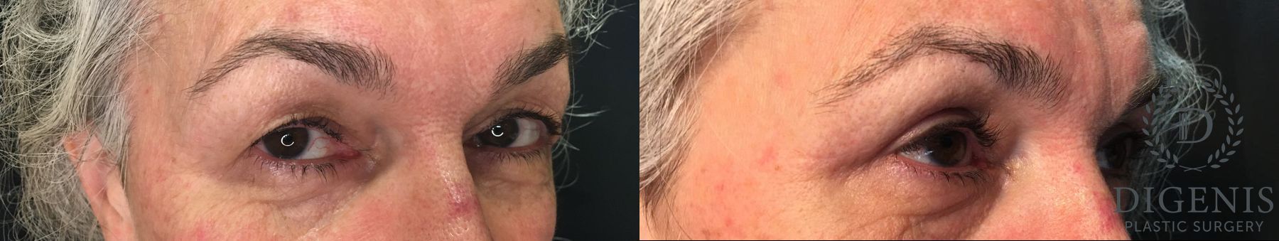 Before and after Eyelid Surgery case 35171 - Angle 2